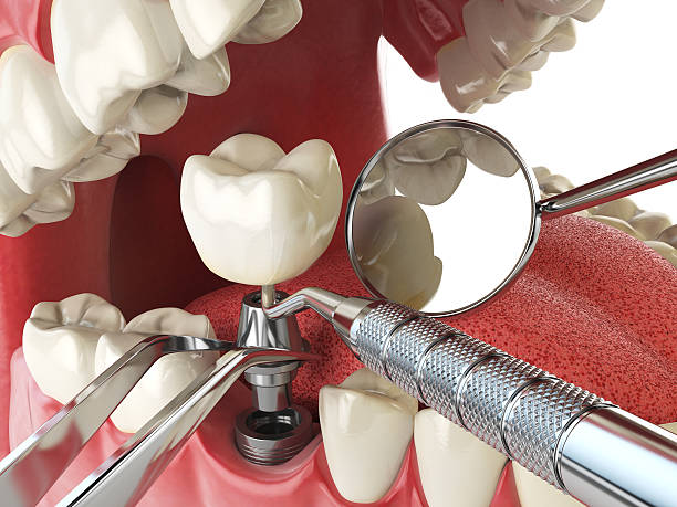 Best Emergency Dentist for Lost Fillings or Crowns in Selinsgrove, PA